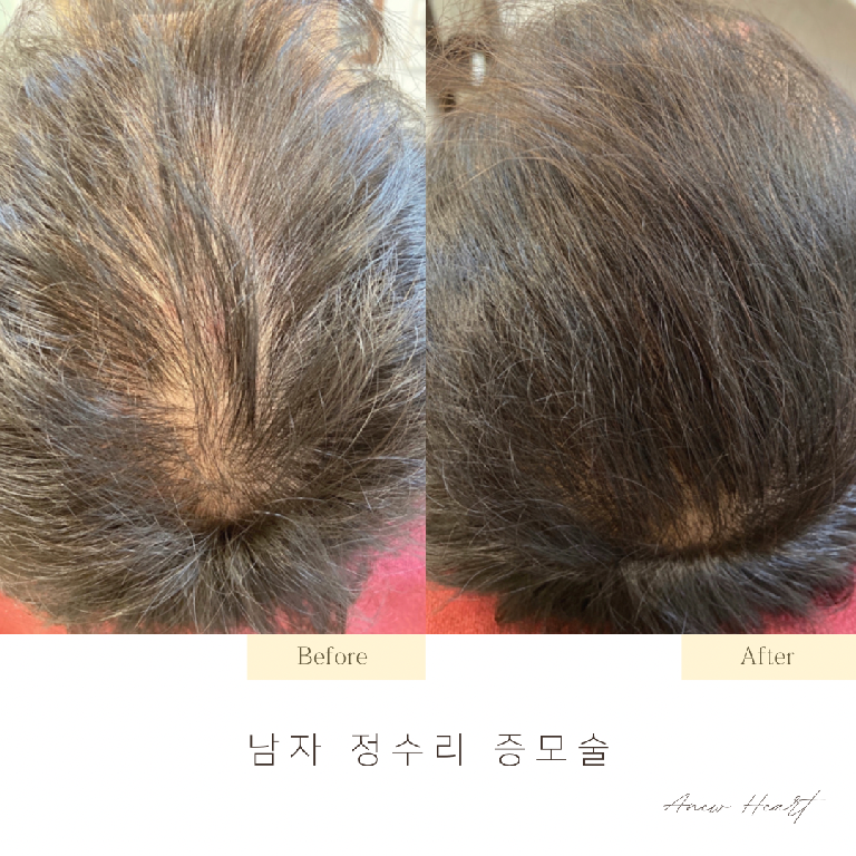 팔로우픽 - followPick | 탈모 증모술 헤어증모술 모델 구합니다!