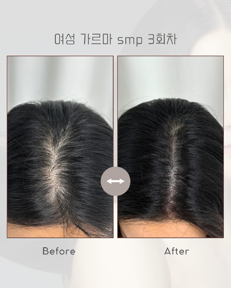 팔로우픽 - followPick | 두피smp 시술 제공